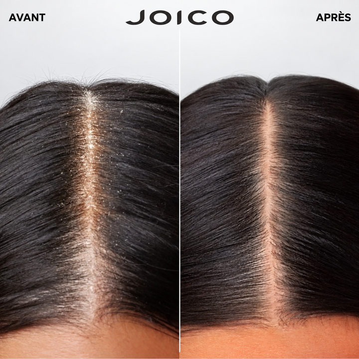 Gros plan avant et après Joico Scalp Vitality d’une raie sur cheveux brun foncé : à gauche, cuir chevelu et cheveux présentant de nombreuses particules blanches visibles; à droite, raie et racines d’apparence plus propres et sans particules visibles, sur fond blanc.