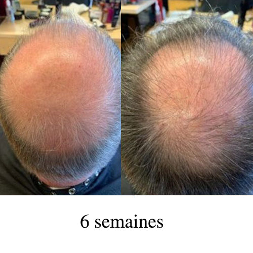 Avant après calvitie homme vertex après 6 semaines, cuir chevelu visible avec amélioration densité cheveux, repousse progressive cheveux clairsemés.