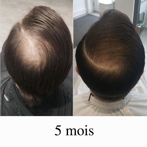 Avant après cheveux clairsemés homme après 5 mois, densité capillaire améliorée avec cheveux plus épais et couverture uniforme du cuir chevelu