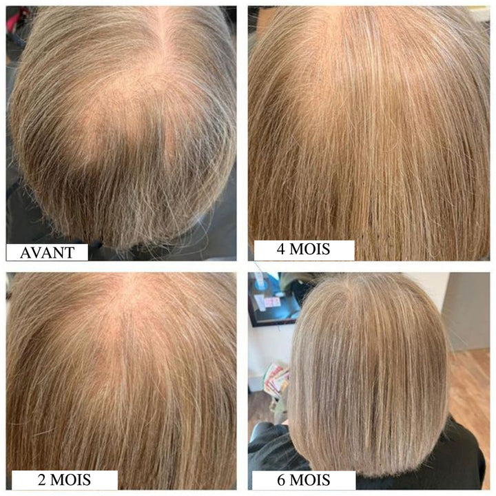 Avant après repousse cheveux femme sur 2, 4 et 6 mois, amélioration progressive de la densité capillaire avec réduction des zones clairsemées sur le dessus du cuir chevelu.