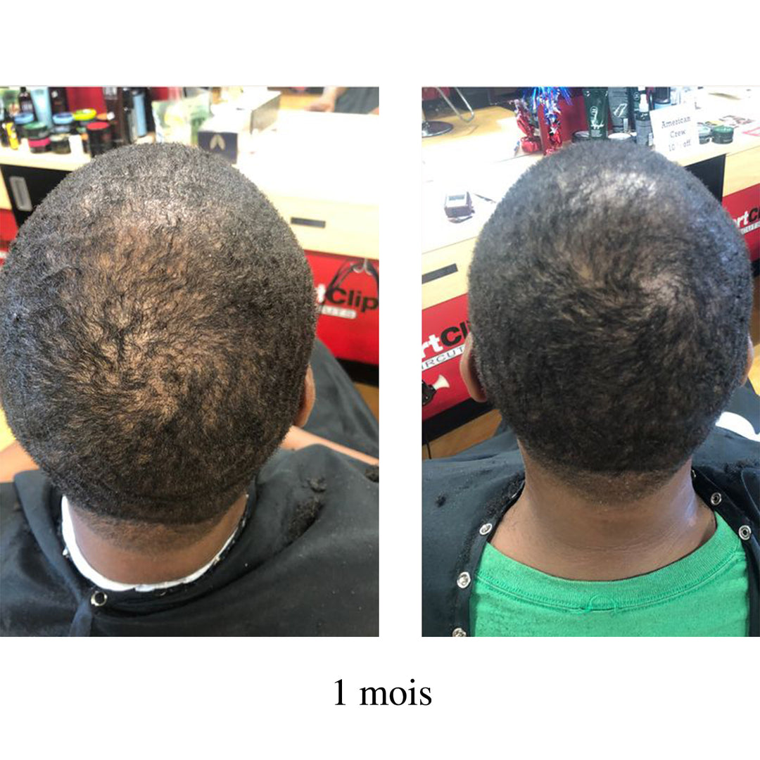 Avant après perte de densité cheveux afro homme après 1 mois, amélioration visible du volume et réduction zones clairsemées sur le sommet du crâne.
