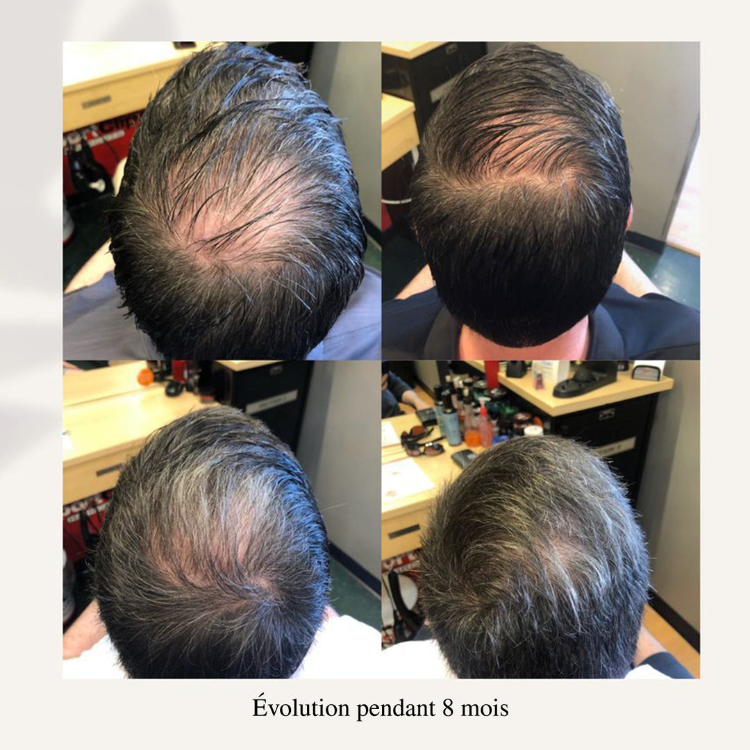 Évolution repousse cheveux homme sur 8 mois, série de photos montrant augmentation progressive densité capillaire et réduction calvitie au vertex.