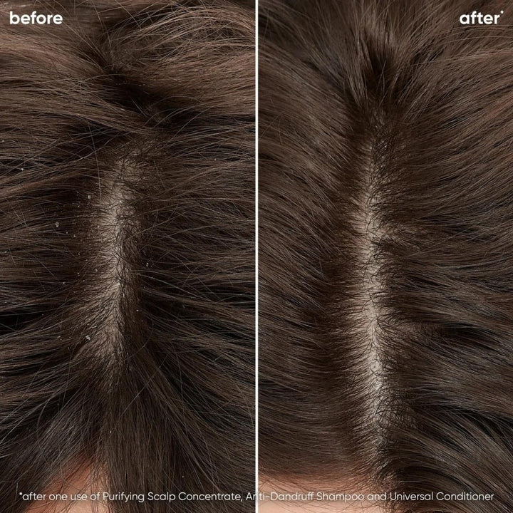 Comparaison avant/après du cuir chevelu avec pellicules visibles à gauche et cuir chevelu propre et sain à droite, après l’utilisation du shampoing antipelliculaire Biolage ScalpSync. Résultat visible dès la première utilisation, effet purifiant.