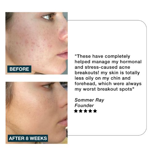 IMARAIS BEAUTY CLARITY contre l'acné